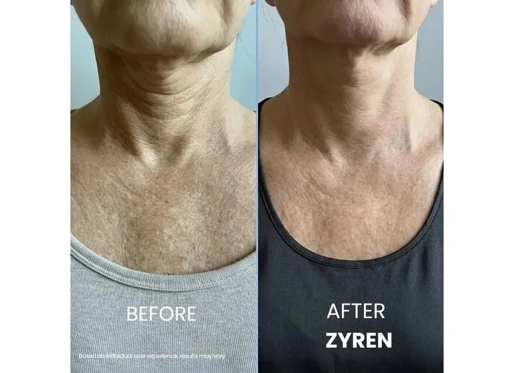Zyren® Tighten & Lift Neck Cream