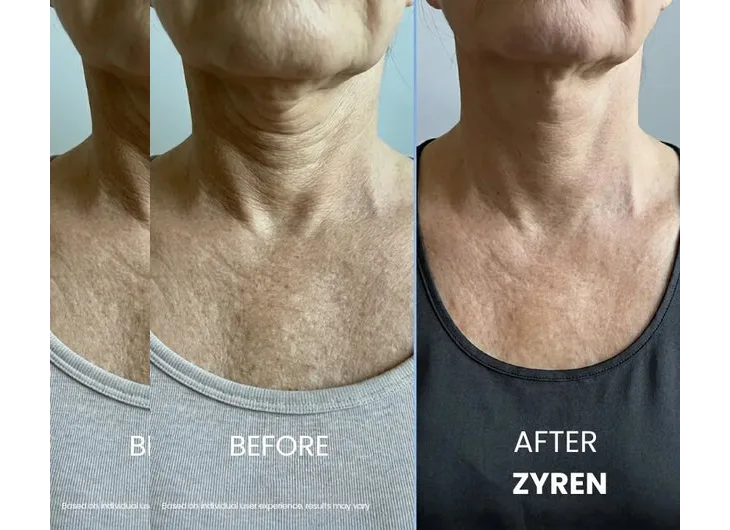 Zyren® Tighten & Lift Neck Cream